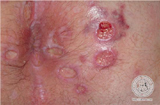 Herpes simplex