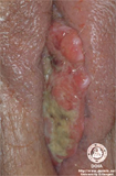 amelanotic malignant melanoma