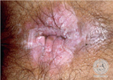 anal eczema